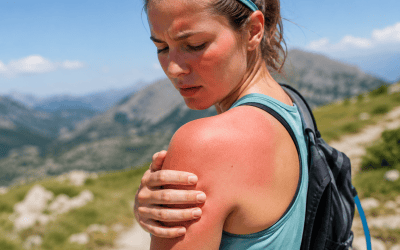 Natürlich wirksam? Hausmittel gegen Sonnenbrand