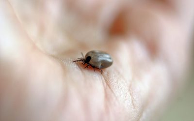 On the rise: meat allergy due to tick bite